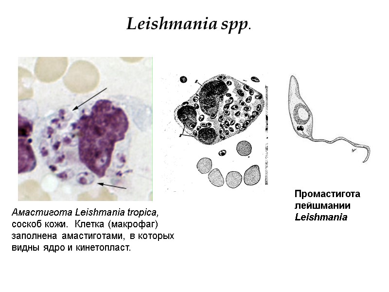 Leishmania spp. Амастигота Leishmania tropica, соскоб кожи.  Клетка (макрофаг) заполнена амастиготами, в которых